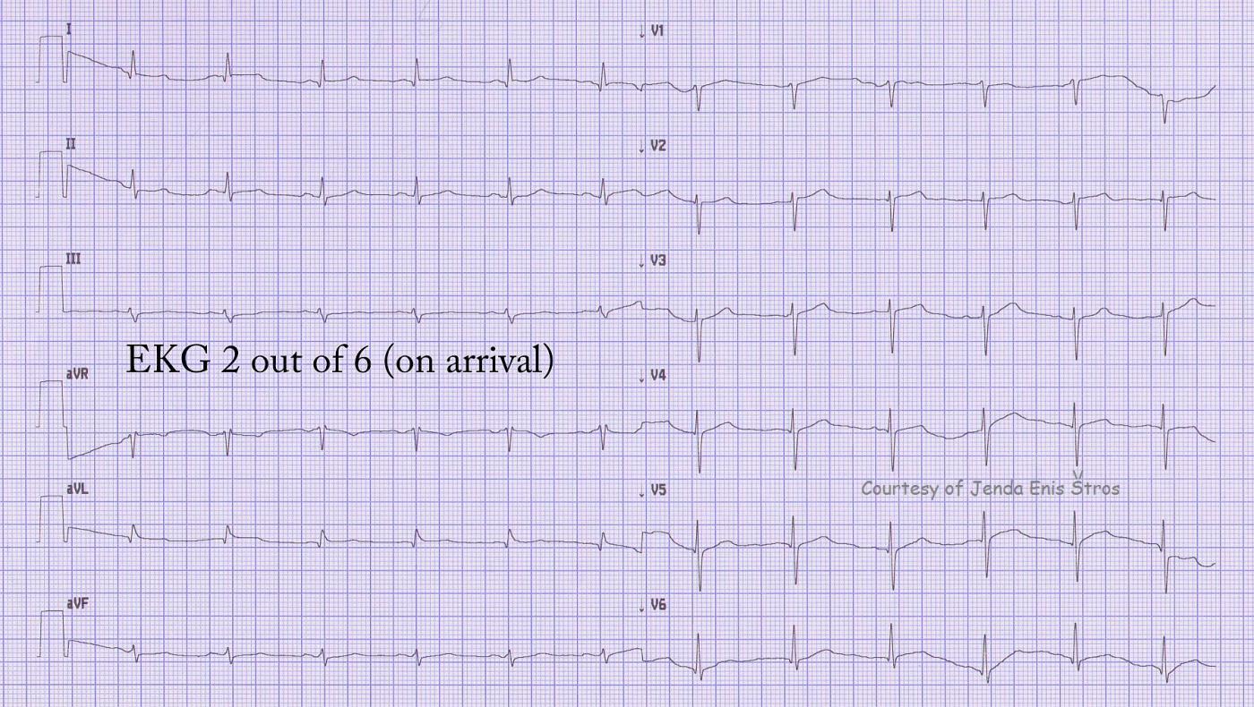 Teaching Series 1113 Ecg 2 Of 6 Acute Anterior Wall M I Ecg Guru